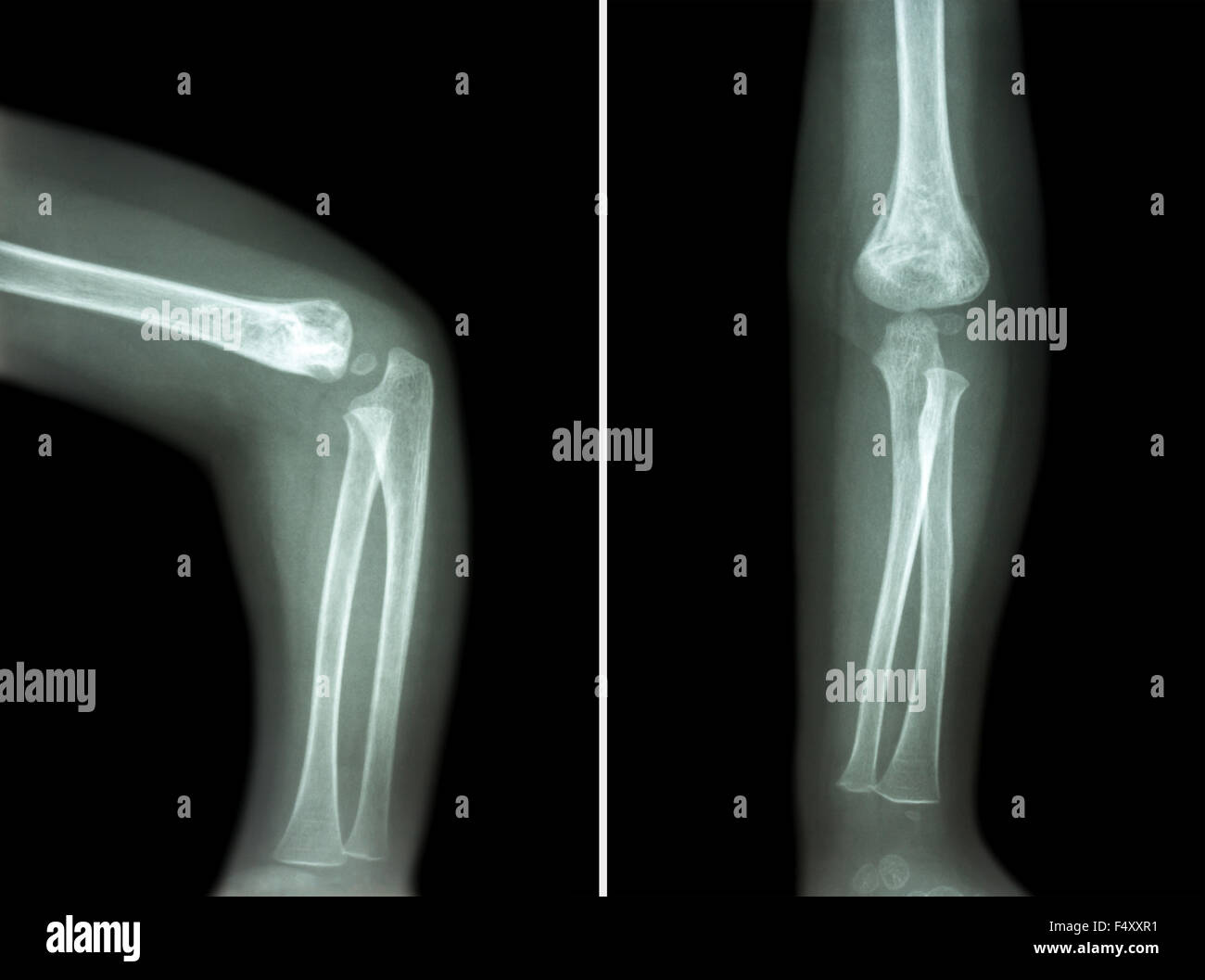 Film x-ray of child 's elbow ( normal child 's elbow ) ( Side and front view , Lateral and Anterior - Posterior view ) ( 2 posit Stock Photo