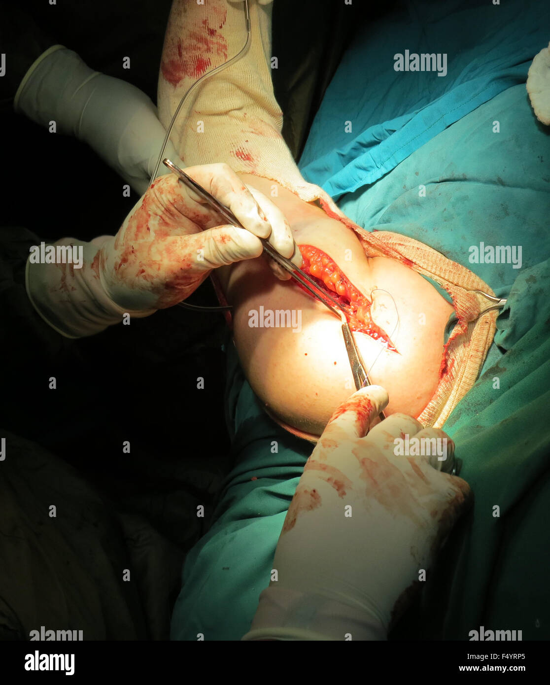 Orthopedic doctors performing a surgery on the injured arm of a patient. Stock Photo
