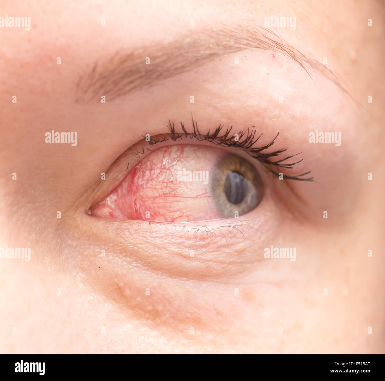 Bloodshot eyeball hires stock photography and images Alamy