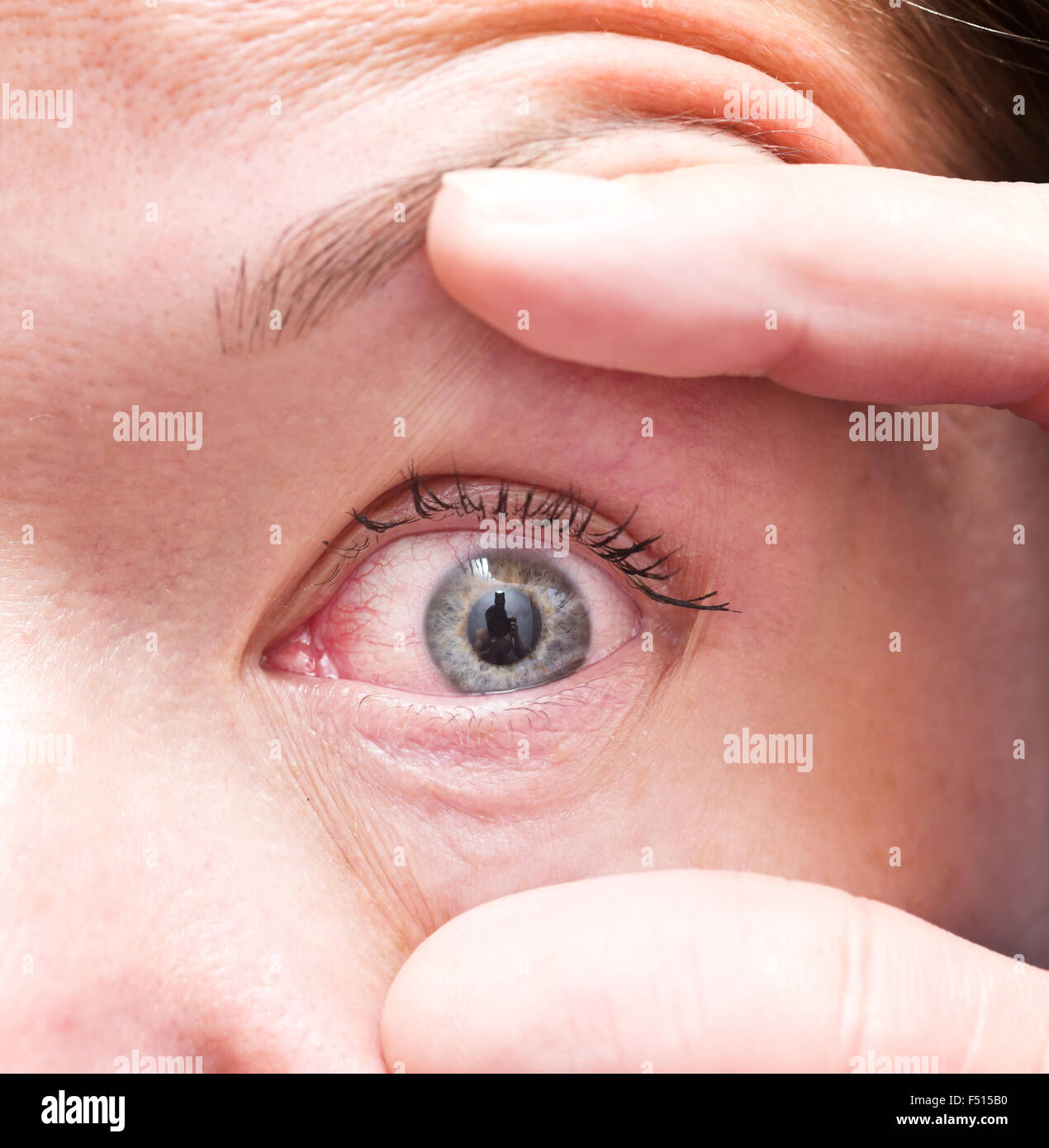 Close up of irritated red bloodshot eye Stock Photo Alamy