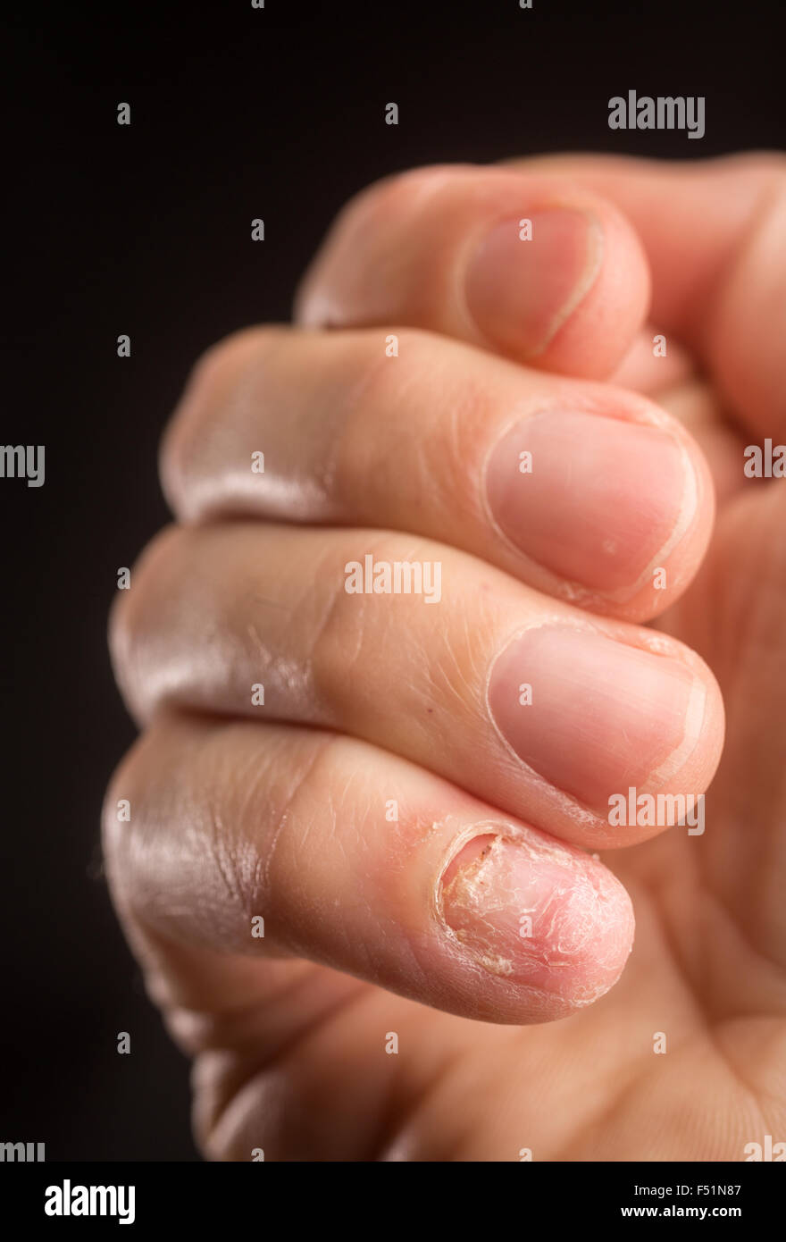 An adult male hand with a missing fingernail Stock Photo