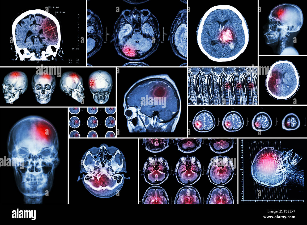 Set , Collection of brain disease ( Cerebral infarction , Hemorrhagic stroke , Brain tumor , Disc herniation with spinal cord co Stock Photo