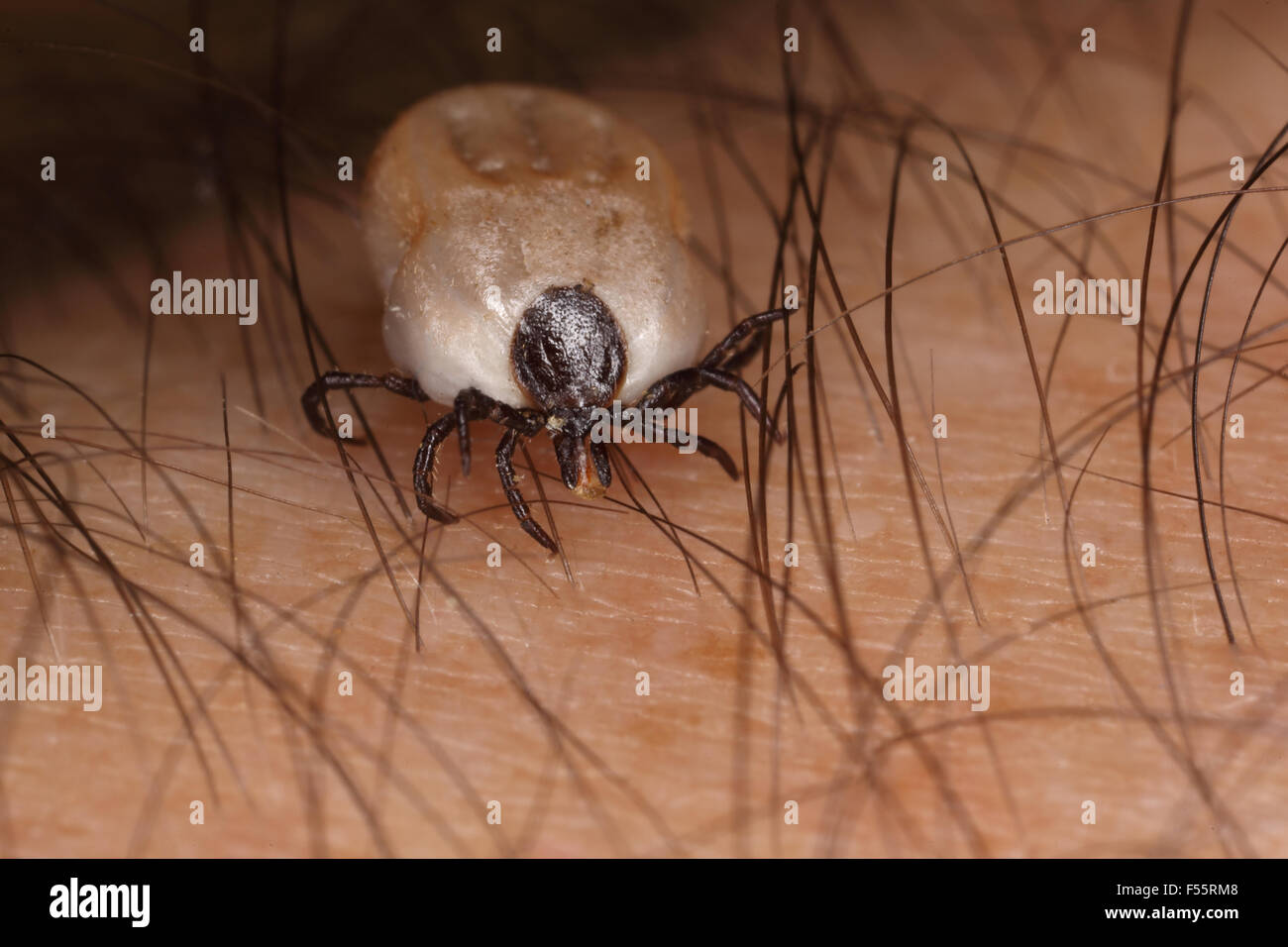 25.04.2015, Berlin , Berlin , Germany  - Moderately soaked tick on human skin. 00S150425D248CAROEX.JPG - NOT for SALE in G E R M A N Y, A U S T R I A, S W I T Z E R L A N D [MODEL RELEASE: YES, PROPERTY RELEASE: NOT APPLICABLE (c) caro photo agency / Sorge, http://www.caro-images.pl, info@carofoto.pl - In case of using the picture for non-journalistic purposes, please contact the agency - the picture is subject to royalty!] Stock Photo