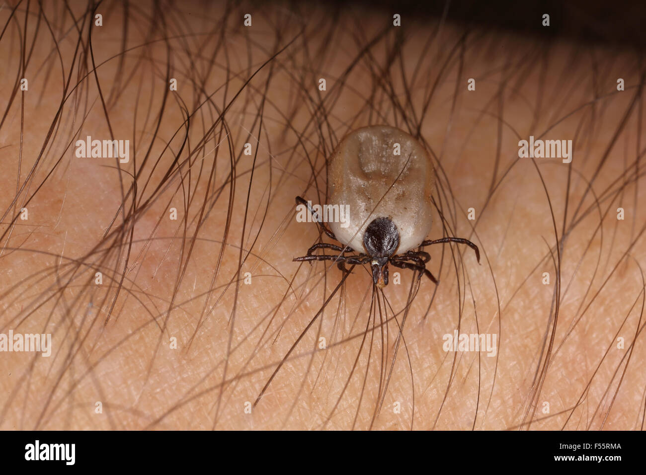 25.04.2015, Berlin , Berlin , Germany  - Moderately soaked tick on human skin. 00S150425D250CAROEX.JPG - NOT for SALE in G E R M A N Y, A U S T R I A, S W I T Z E R L A N D [MODEL RELEASE: YES, PROPERTY RELEASE: NOT APPLICABLE (c) caro photo agency / Sorge, http://www.caro-images.pl, info@carofoto.pl - In case of using the picture for non-journalistic purposes, please contact the agency - the picture is subject to royalty!] Stock Photo