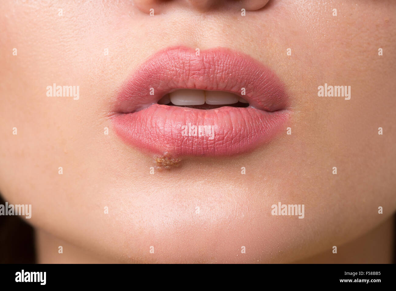 beautiful lips virus infected herpes Stock Photo