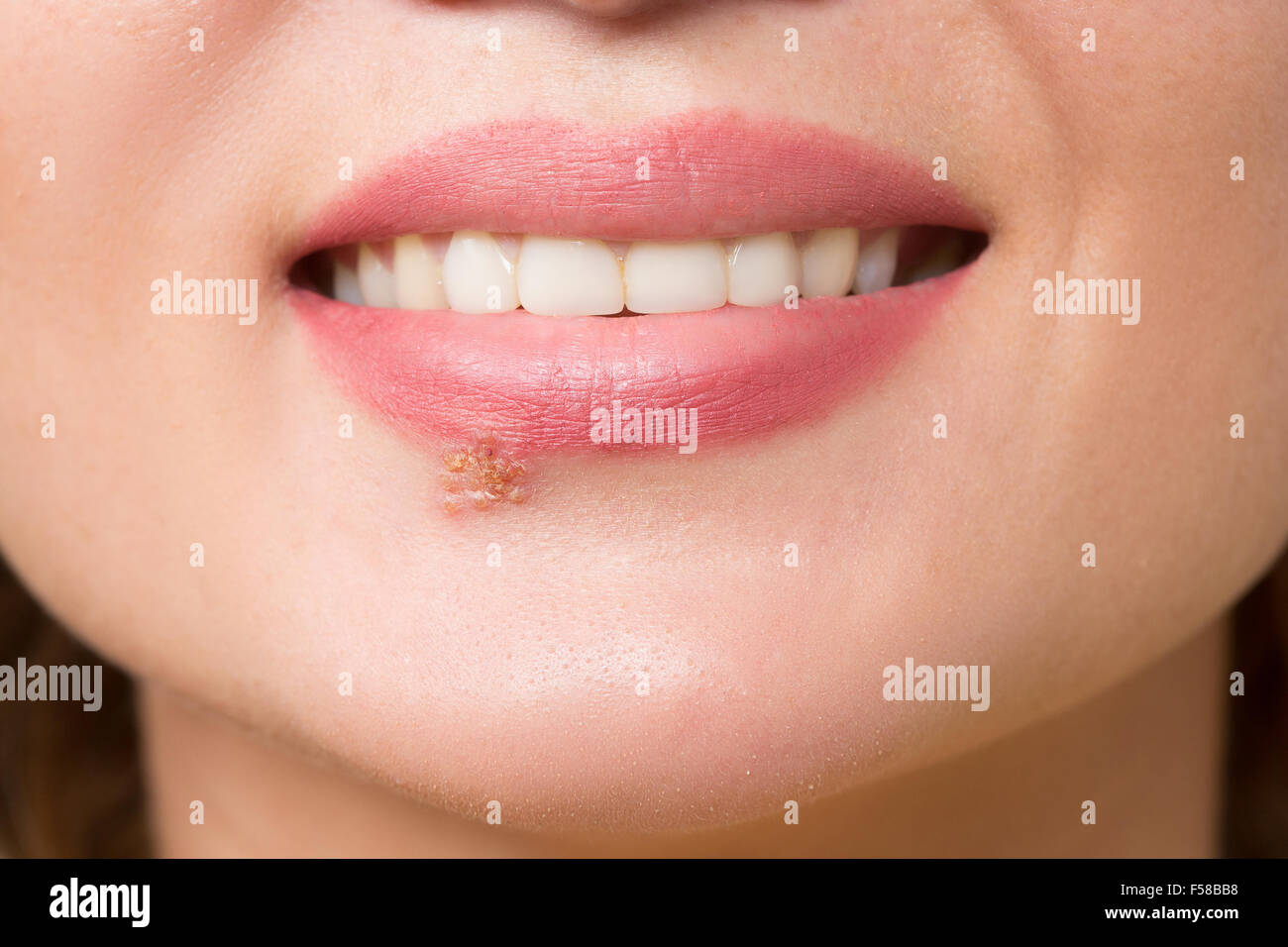 beautiful lips virus infected herpes Stock Photo Alamy