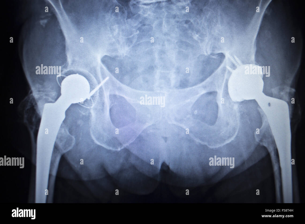 Xray scan image of hip joints with orthopedic hip joint replacement