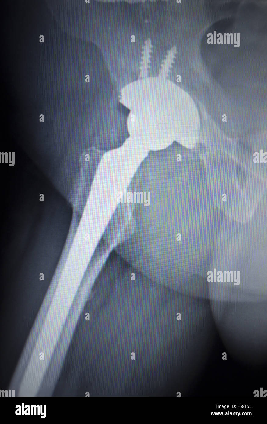 X-ray scan image of hip joints with orthopedic hip joint replacement ...
