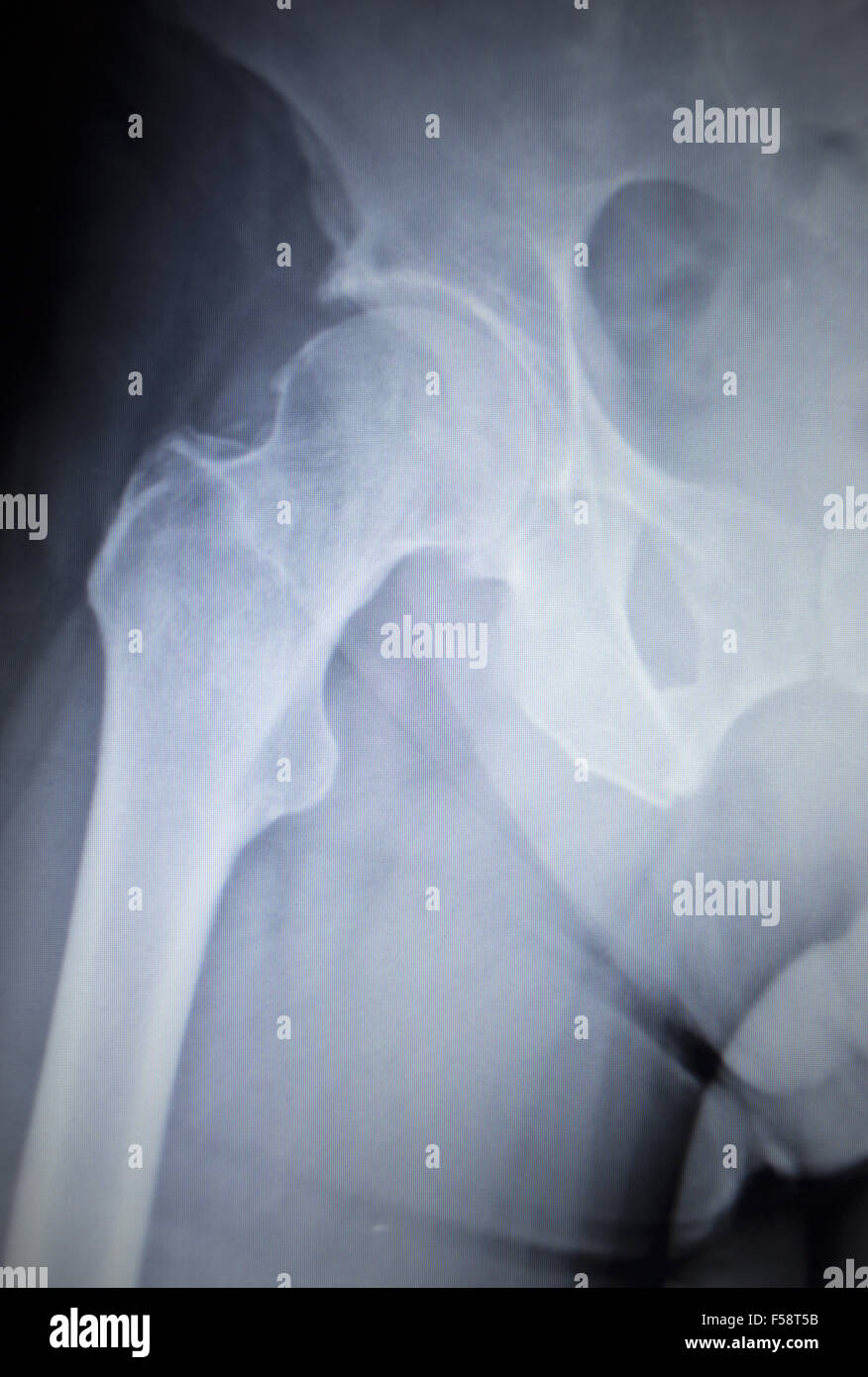 Xray scan image of hip joints with orthopedic hip joint replacement