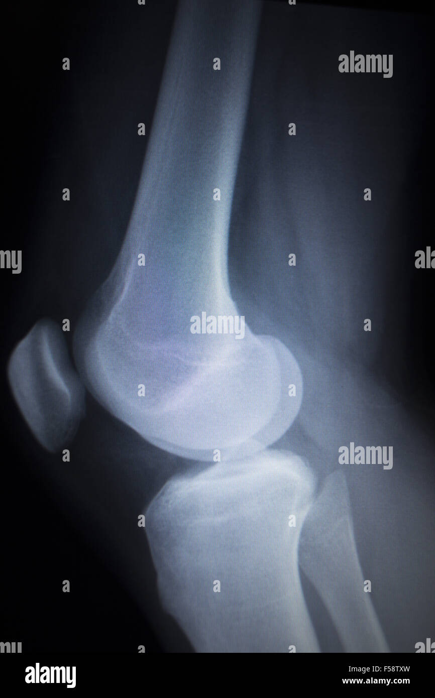 X-ray orthopedic medical CAT scan of painful knee meniscus injury leg ...
