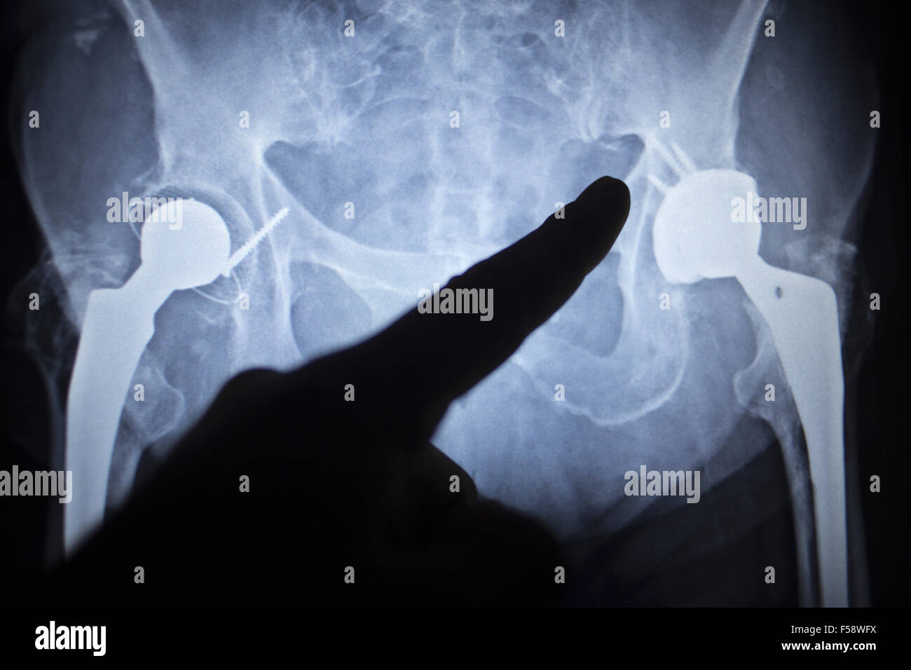 Xray scan image of hip joints with orthopedic hip joint replacement