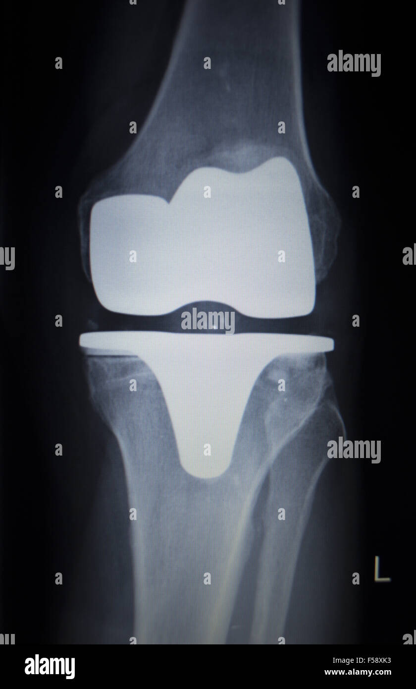 X-ray orthopedic medical CAT scan of painful knee meniscus injury leg ...