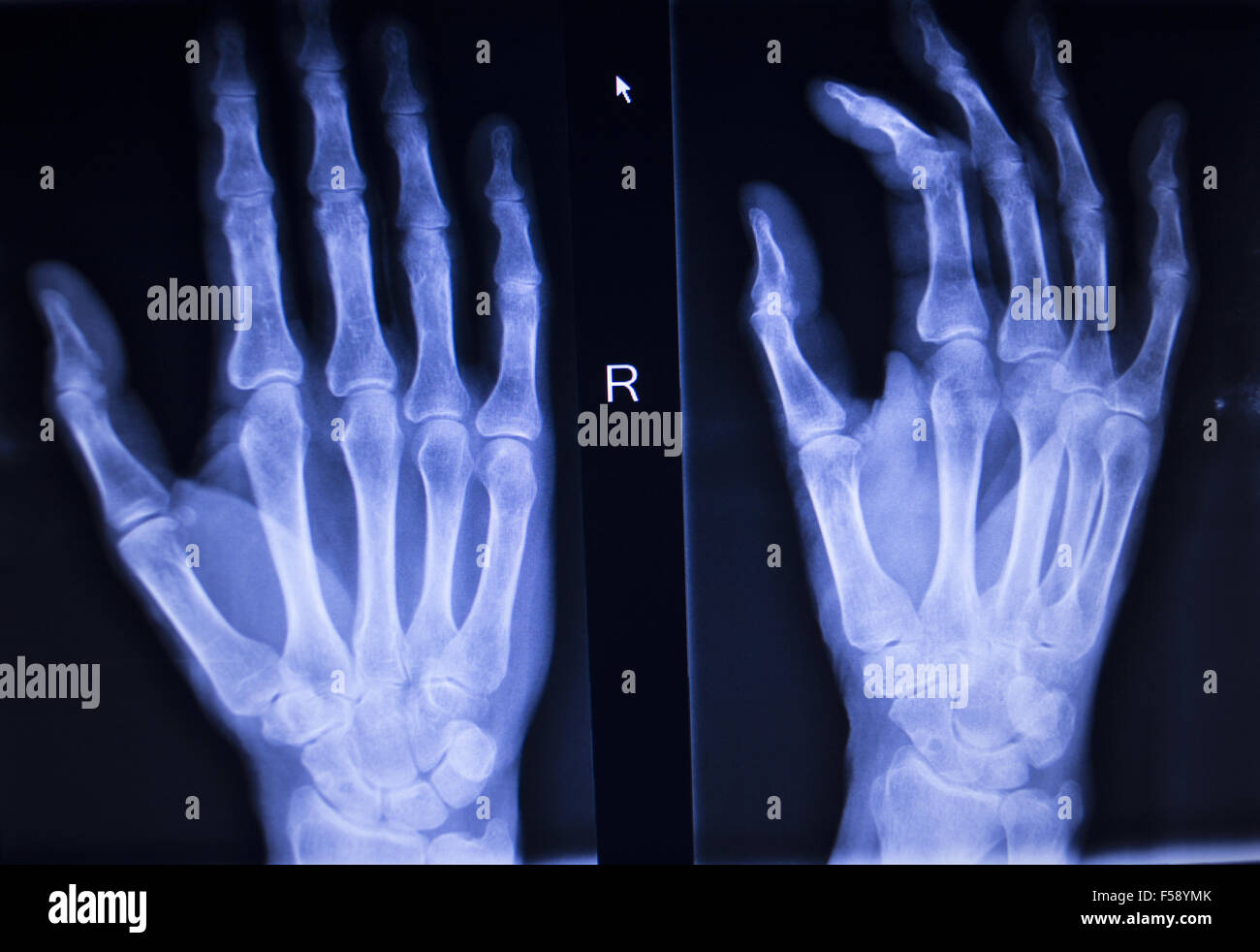 Xray orthopedic medical CAT scan of painful hand fingers thumb injury