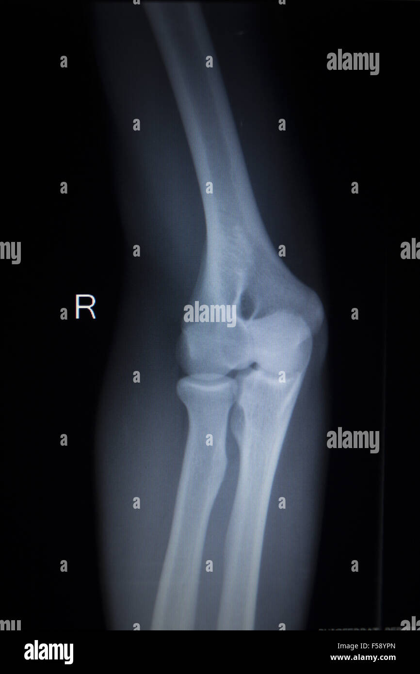 Xray orthopedic medical CAT scan of painful tennis elbow injury in