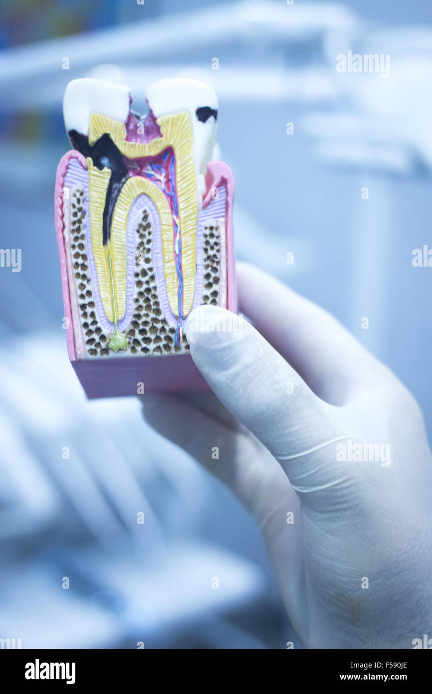 Dental tooth model cast showing decay casing pain, enamel and roots in ...