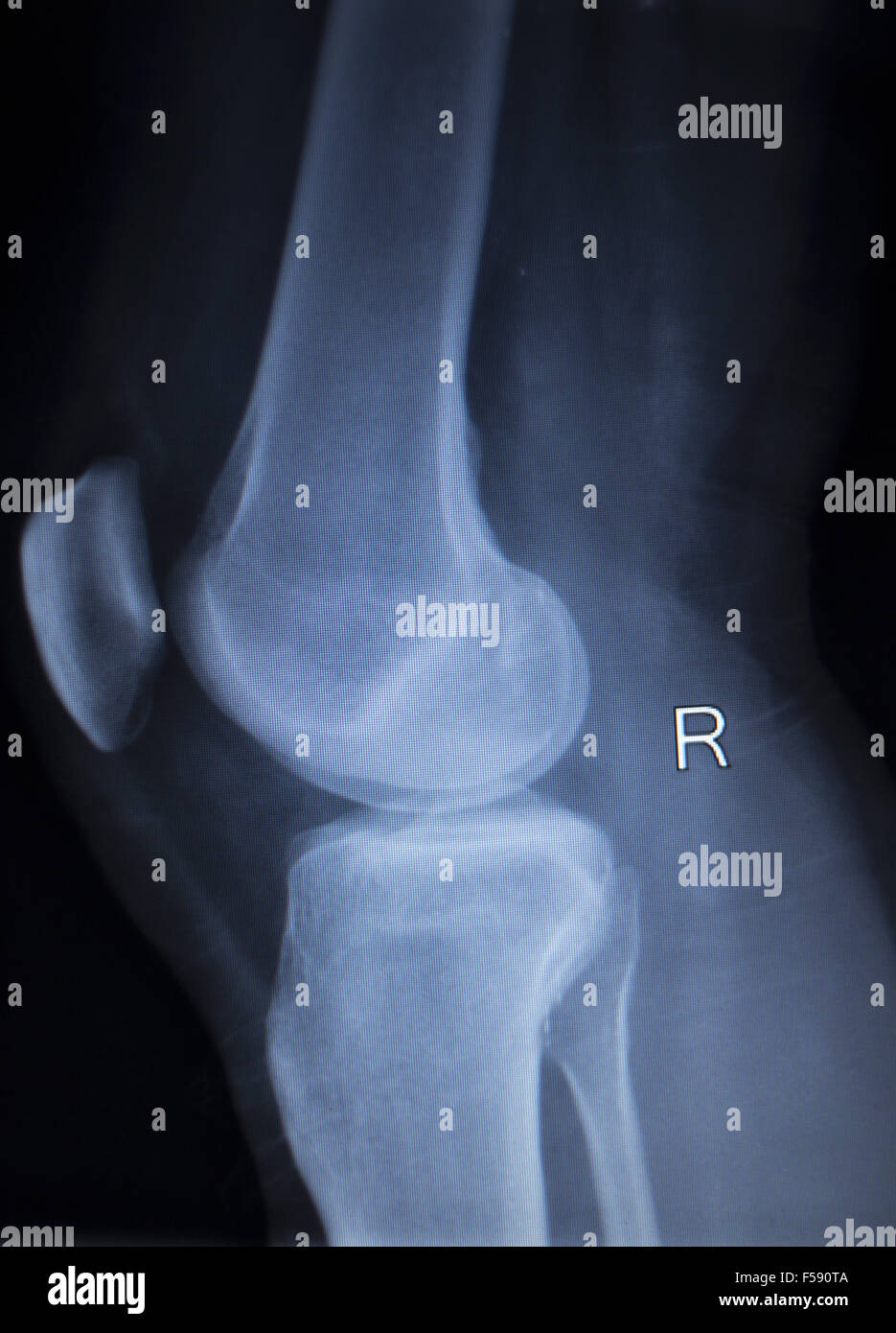 X-ray orthopedic medical CAT scan of painful knee meniscus injury leg ...