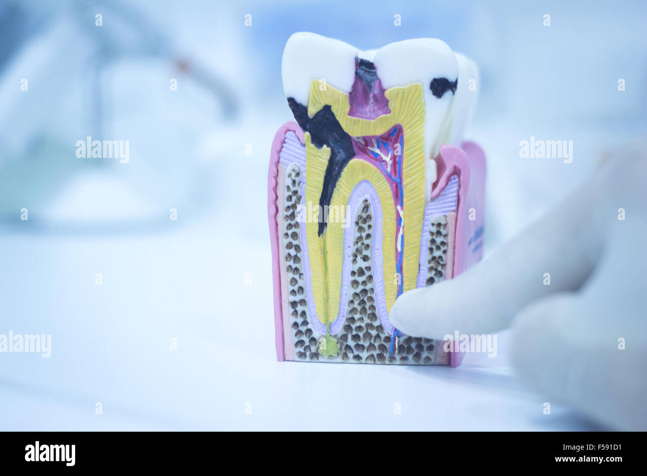 Dental tooth model cast showing decay casing pain, enamel and roots in ...