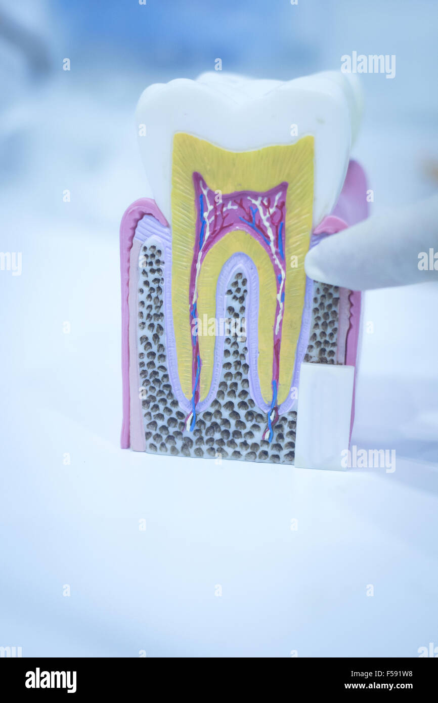 Dental tooth model cast showing decay casing pain, enamel and roots in ...