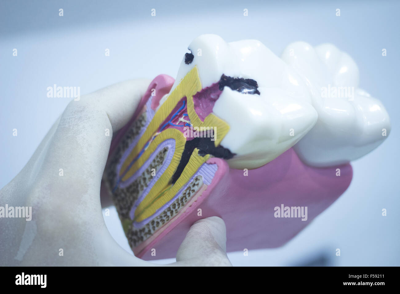 Dental tooth model cast showing decay casing pain, enamel and roots in ...