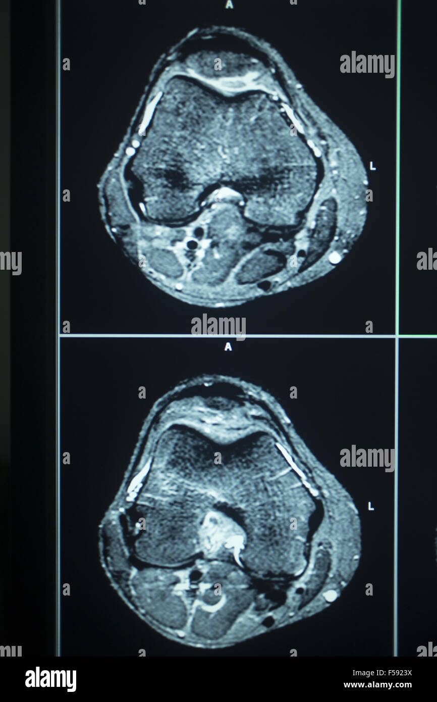 MRI magentic resonance imaging nuclear scanning scan test results knee