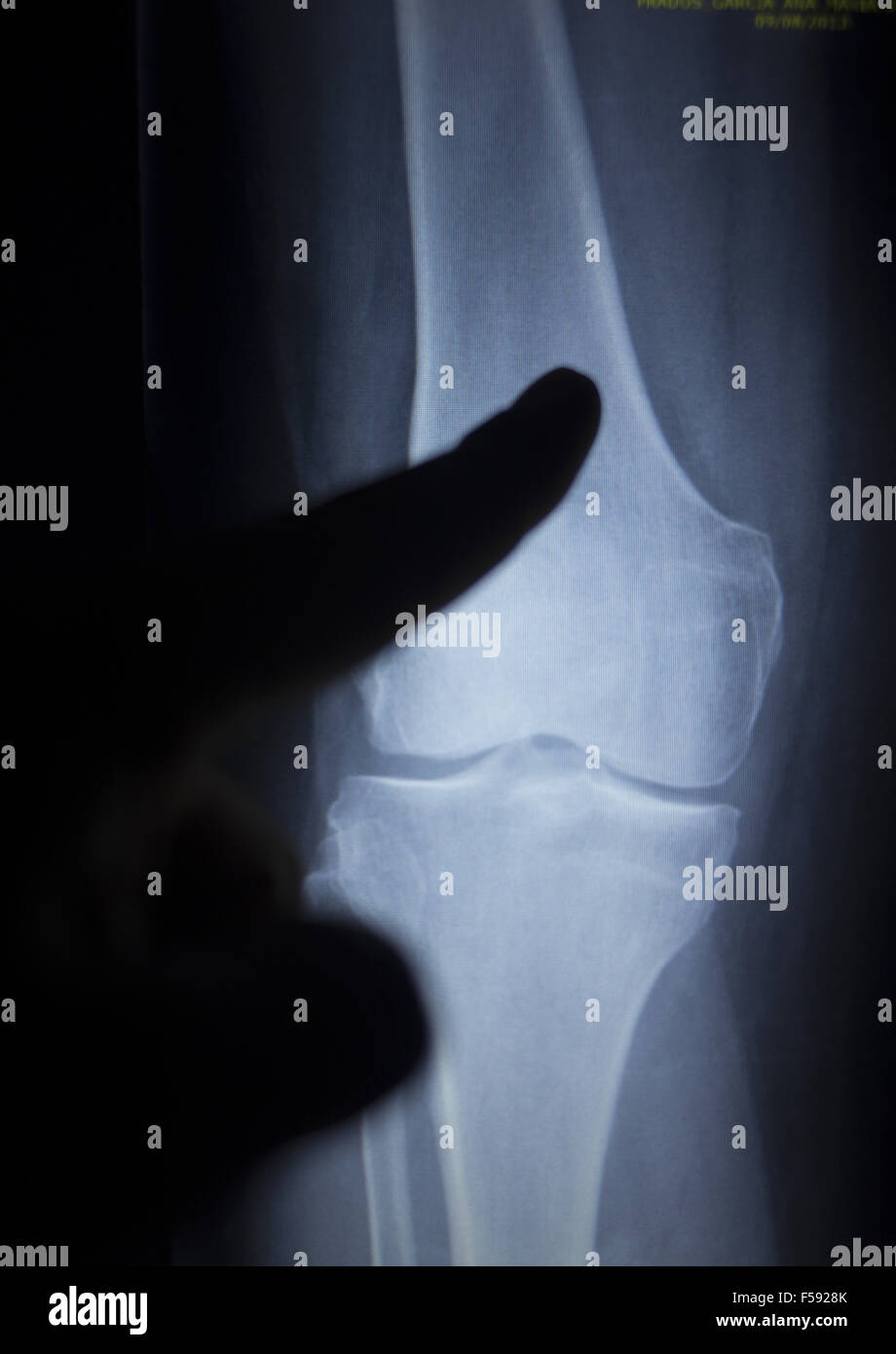 X-ray orthopedic medical CAT scan of painful knee meniscus injury leg ...
