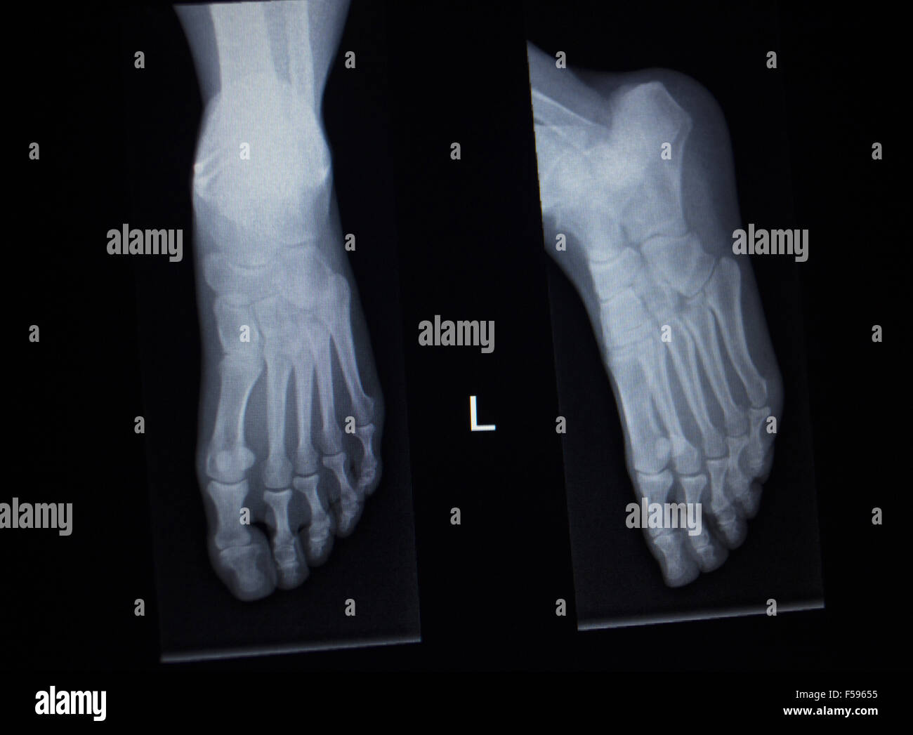 X-ray orthopedic medical anterior posterior AP CAT scan of painful foot ...