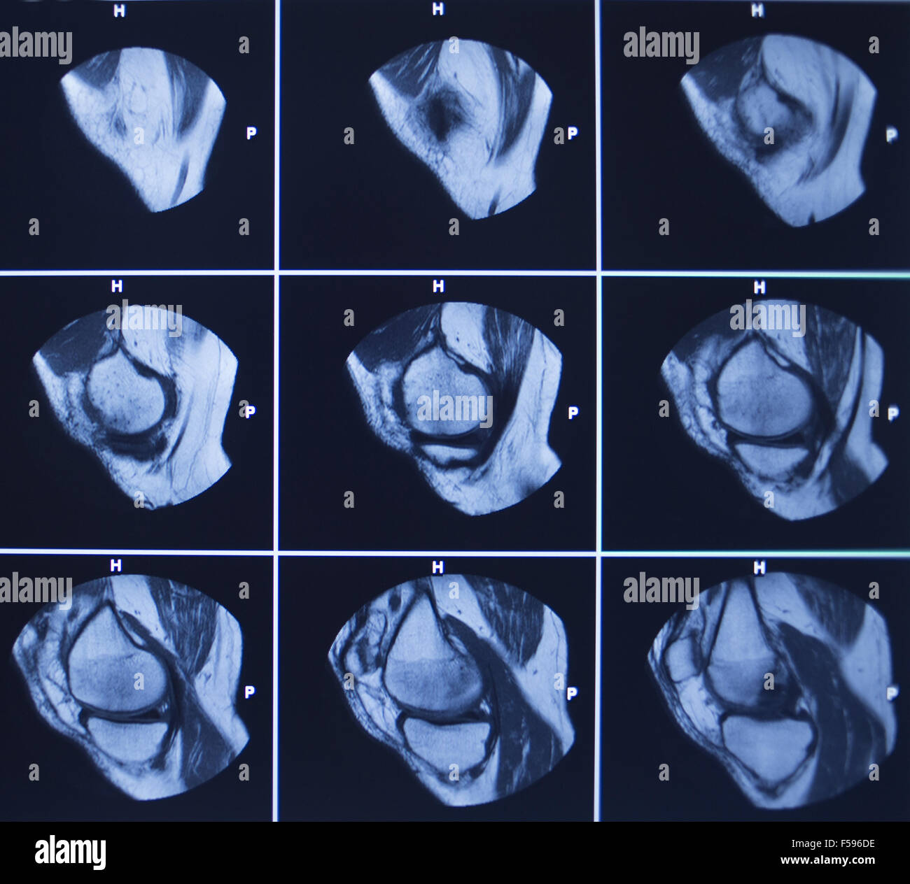 MRI magentic resonance imaging nuclear scanning scan test results knee