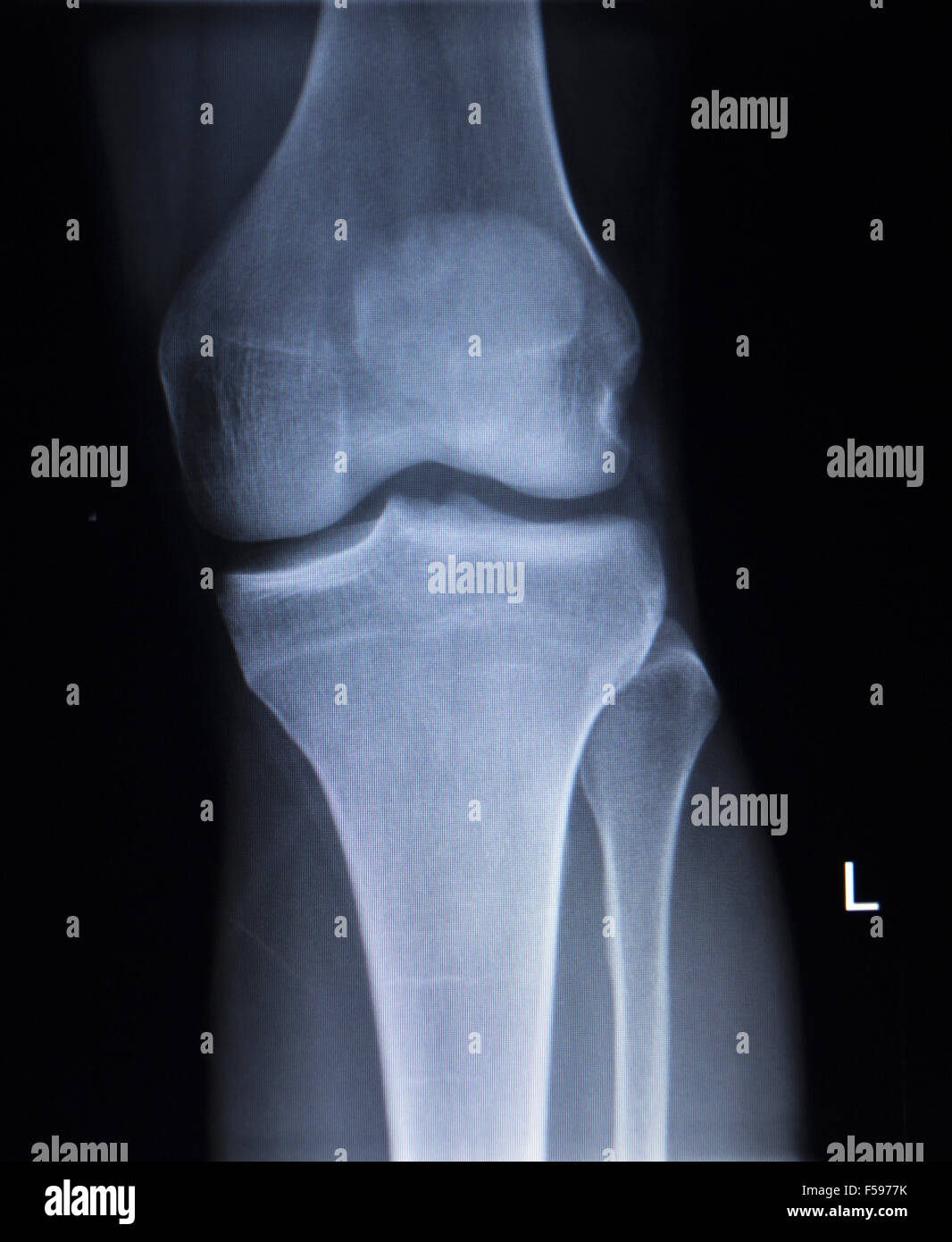 X-ray orthopedic medical CAT scan of painful knee meniscus injury leg ...