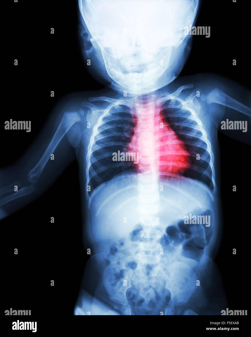Film x-ray whole child 's body with heart disease ( Rheumatic heart disease , Valvular heart disease ) ( Cardiovascular system ) Stock Photo