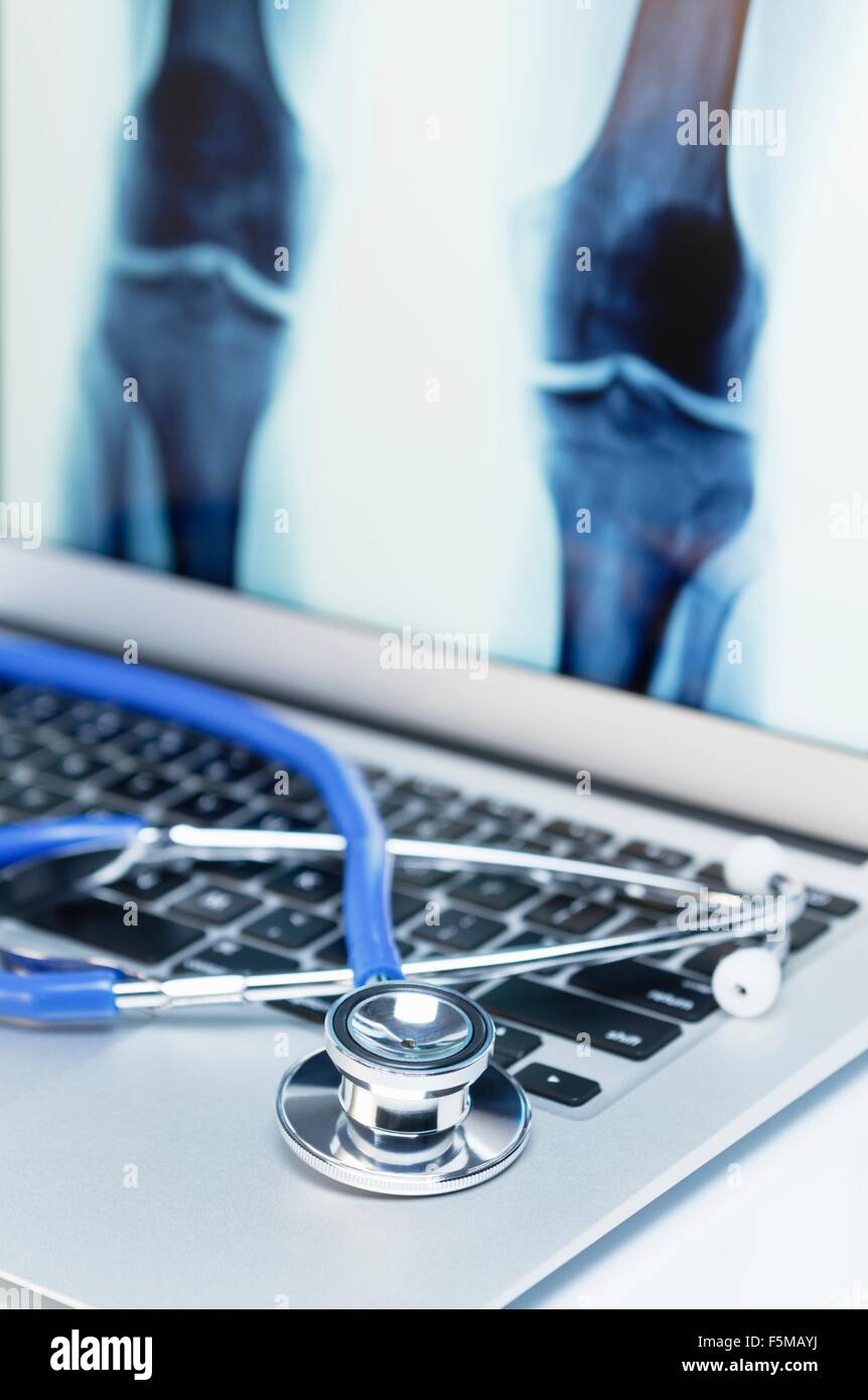 Modern orthopedics. Acoustic stethoscope on an  laptop computer that displays an anteroposterior X-Ray image of knees Stock Photo