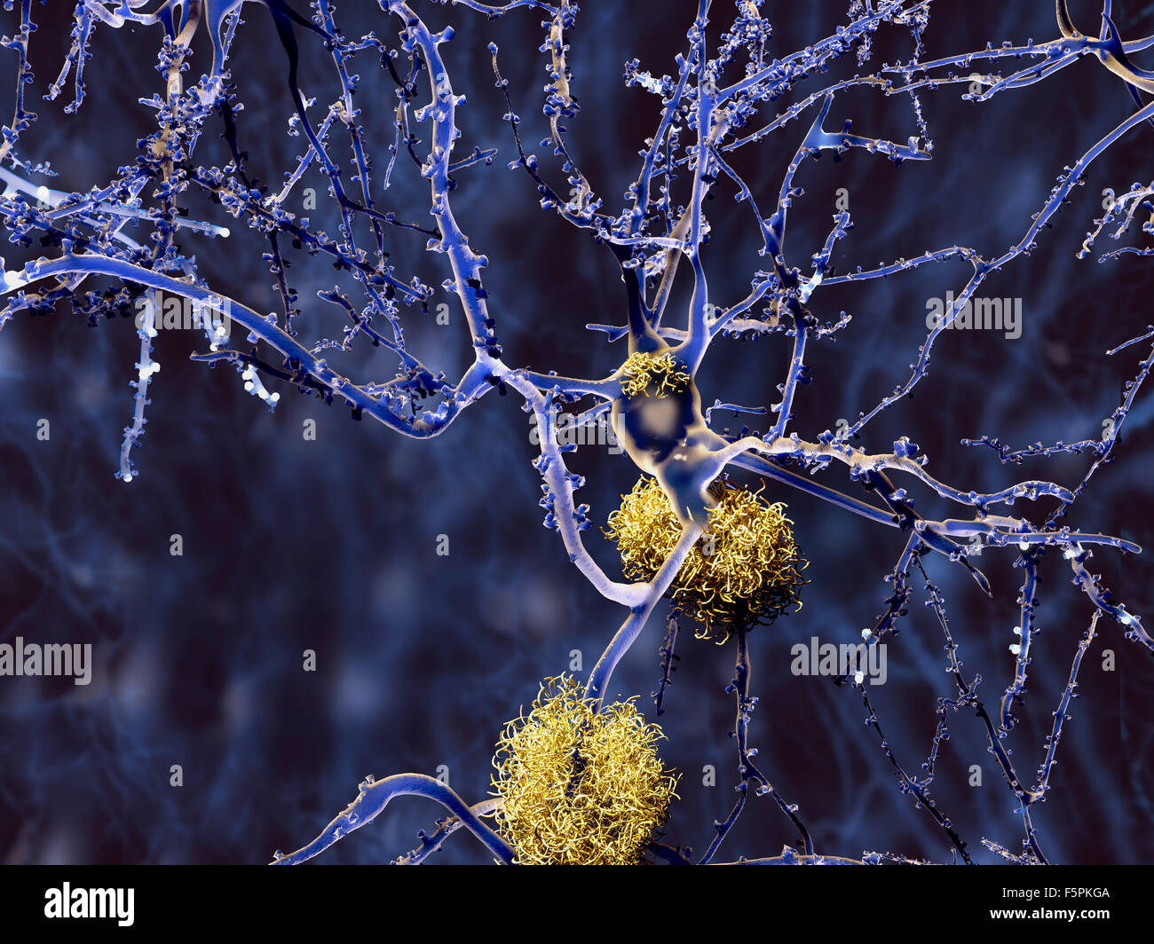 Alzheimer's disease. Computer illustration of amyloid plaques amongst neurons. Amyloid plaques are characteristic features of Stock Photo