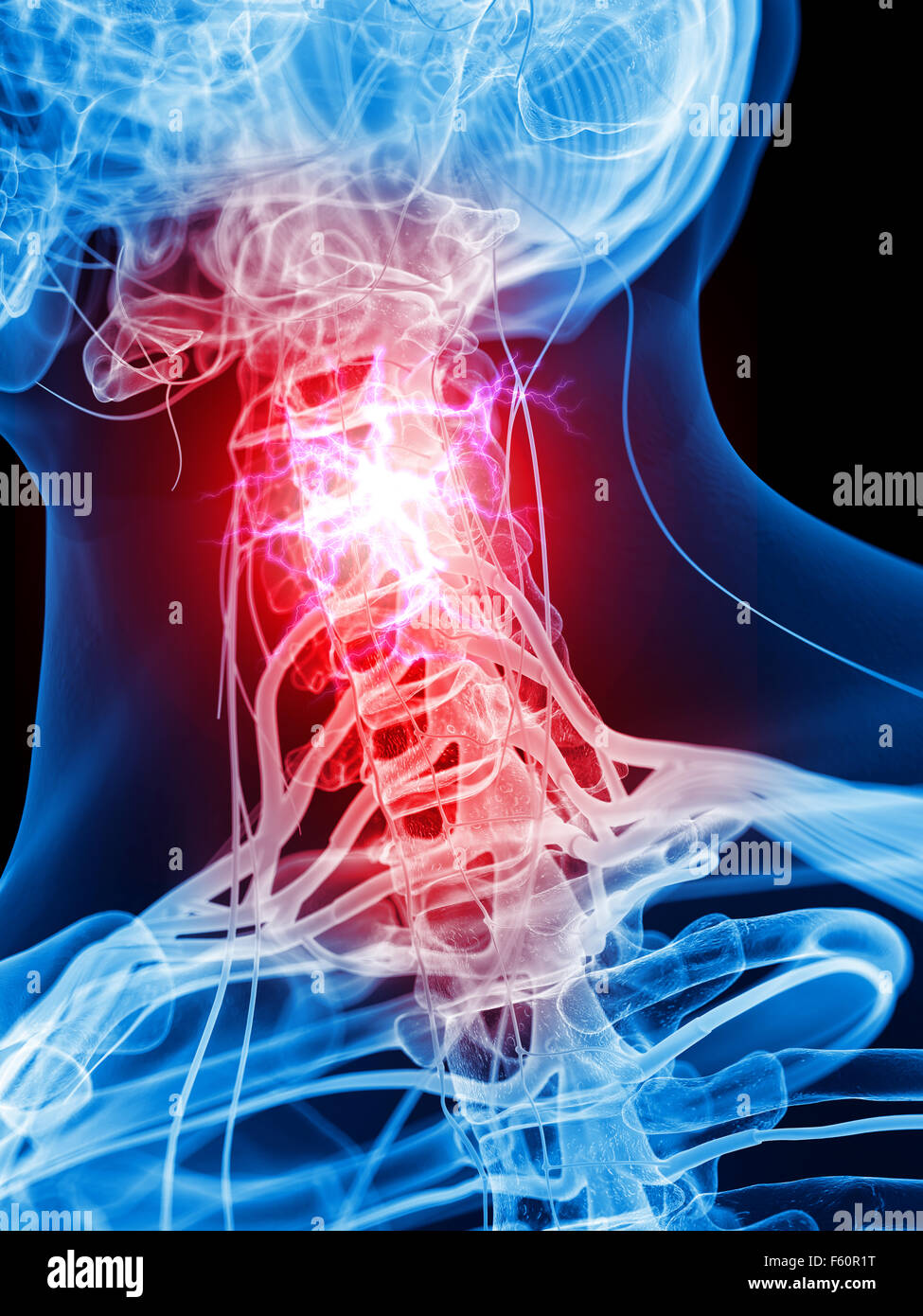 medically accurate illustration of painful cervical nerves Stock Photo