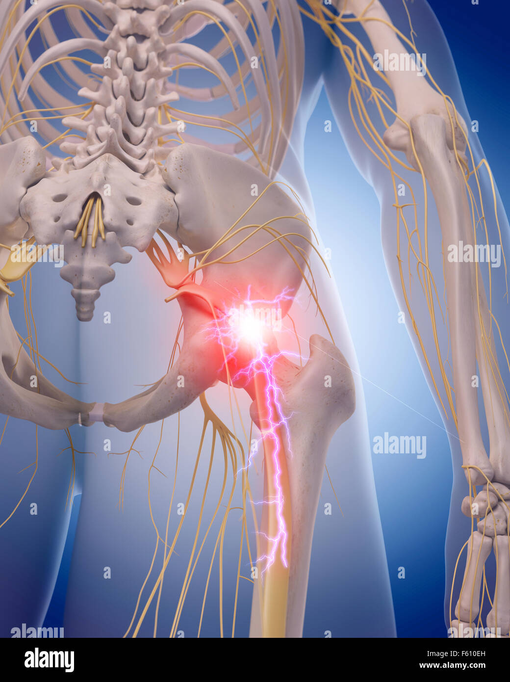 medically accurate illustration of a painful sciatic nerve Stock Photo