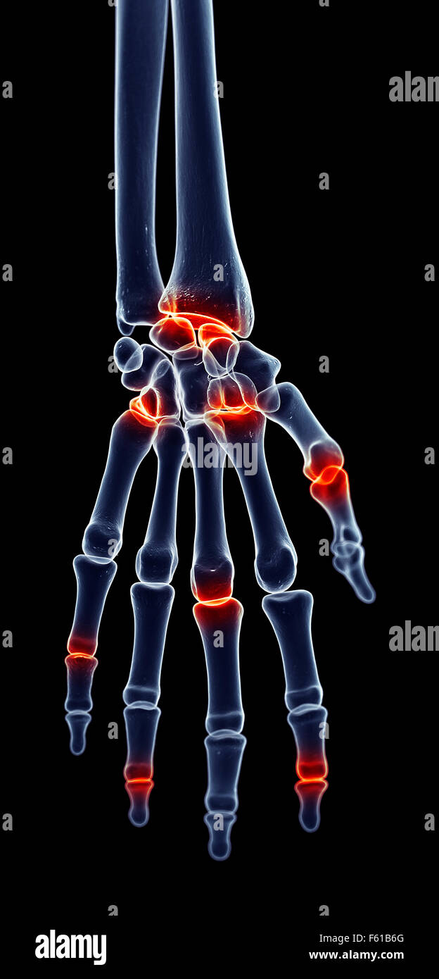 medically accurate illustration painful finger joints Stock Photo Alamy