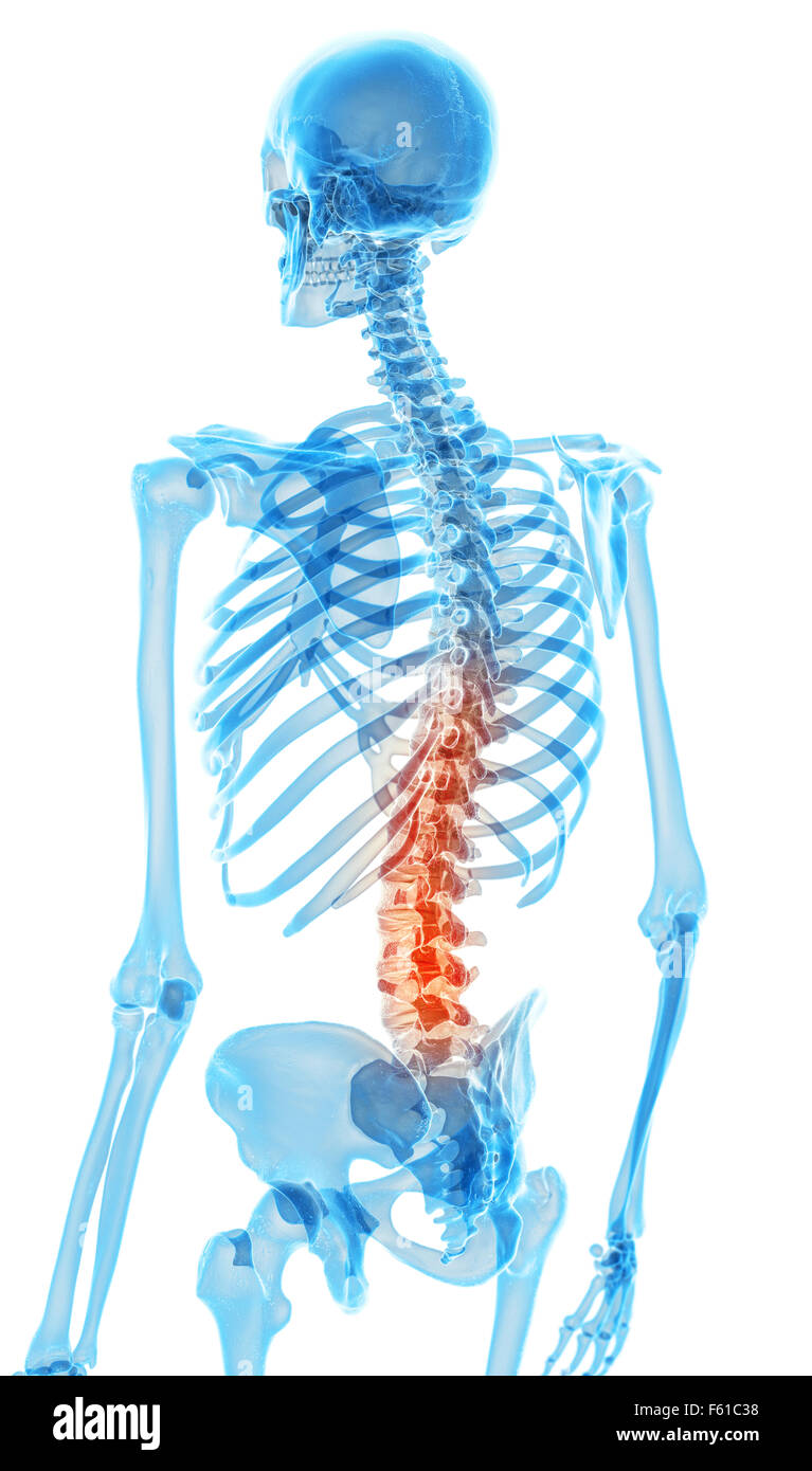 medically accurate illustration - painful lumbar spine Stock Photo - Alamy