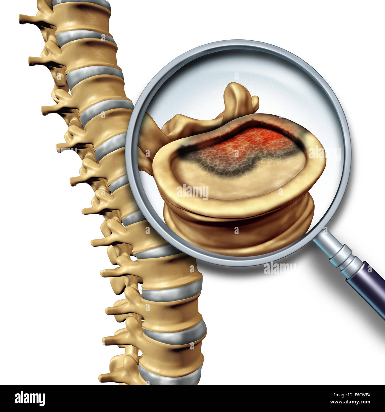 Spine cancer and spinal tumor disease medical concept as skeletal vertebra with a magnifying glass close up of a vertabrate with a cancerous growth. Stock Photo