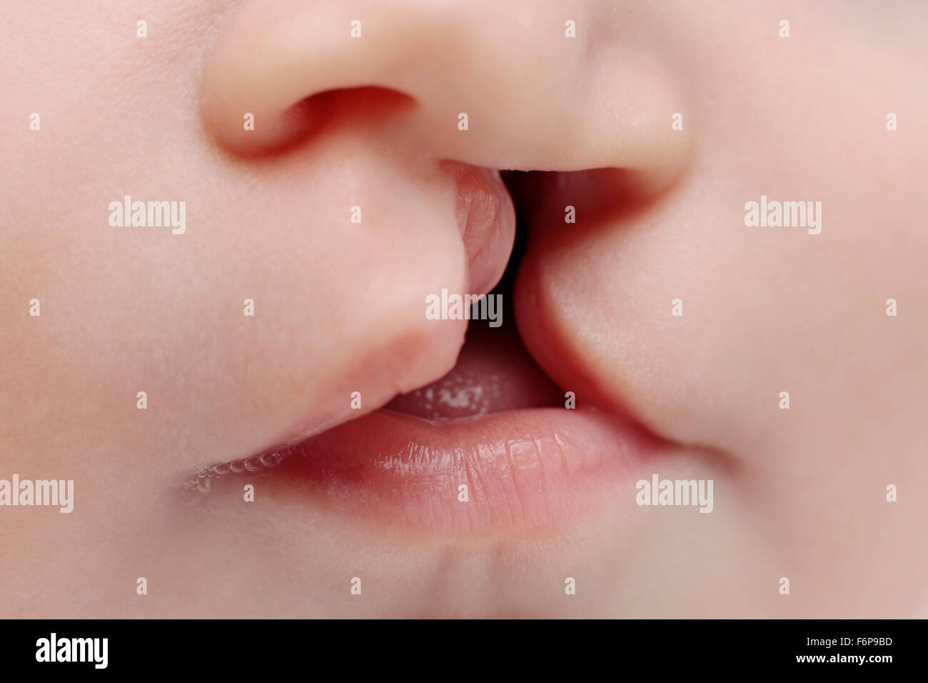 Closeup on lips of a baby with lips and palate cleft. Stock Photo