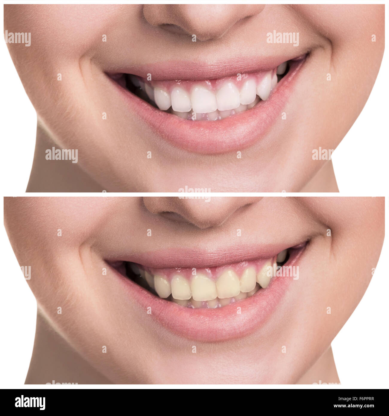 Young woman with healthy smile. Before, after concept Stock Photo - Alamy