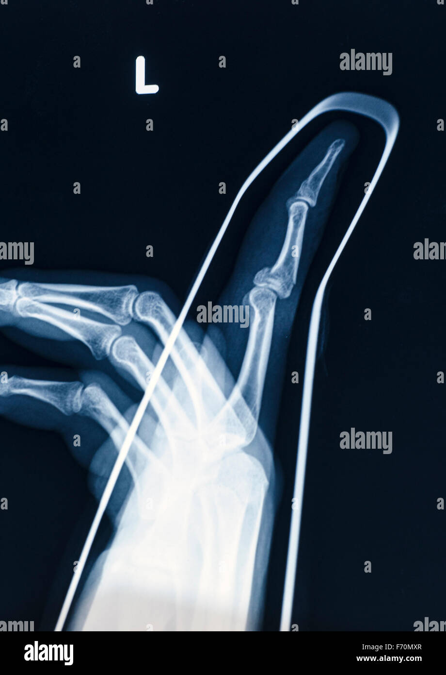 X-Ray image of human hand with stick for fracture Stock Photo