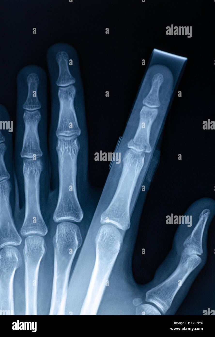 X-Ray image of human hand with stick for fracture Stock Photo