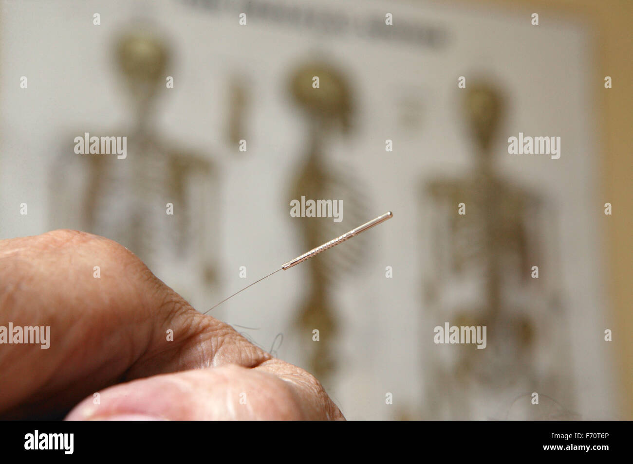 Acupuncture needle in hand Stock Photo Alamy