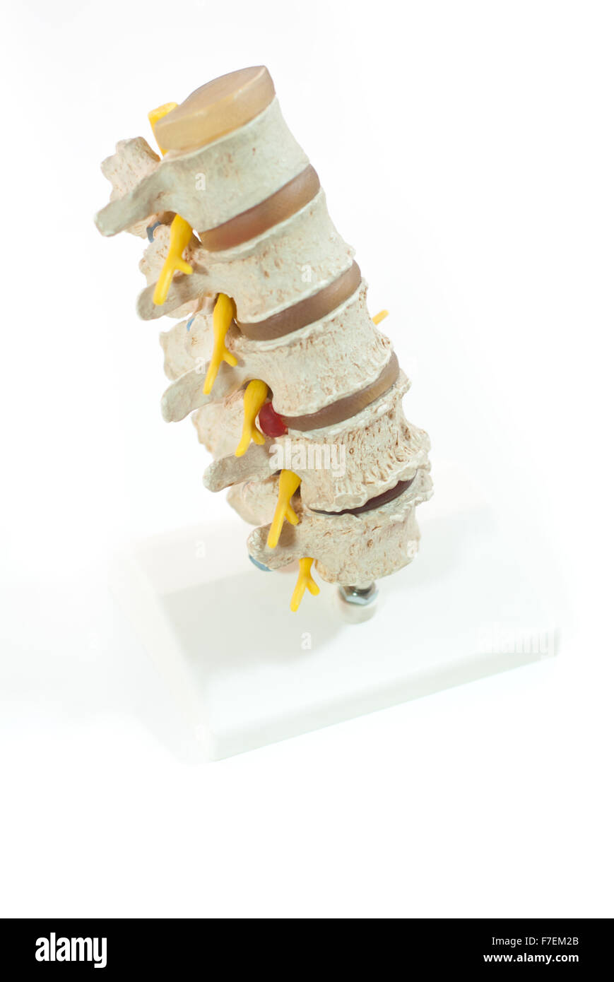 a model of disc herniation Stock Photo