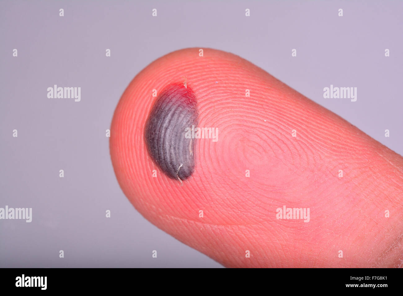 Blood blister on finger tip from crush injury Stock Photo Alamy