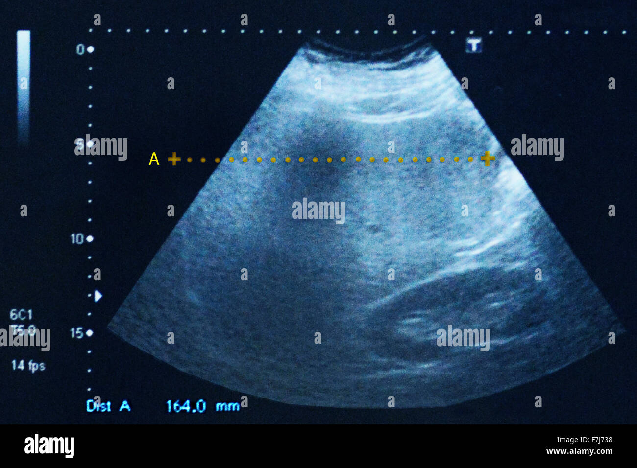 Hepatomegaly Ultrasound Stock Photo Alamy Hepatomegaly Ultrasound Stock Photo Alamy