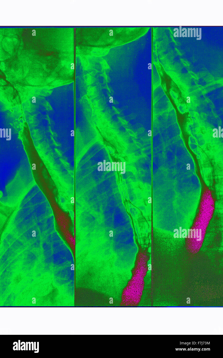 ESOPHAGUS, XRAY Stock Photo Alamy
