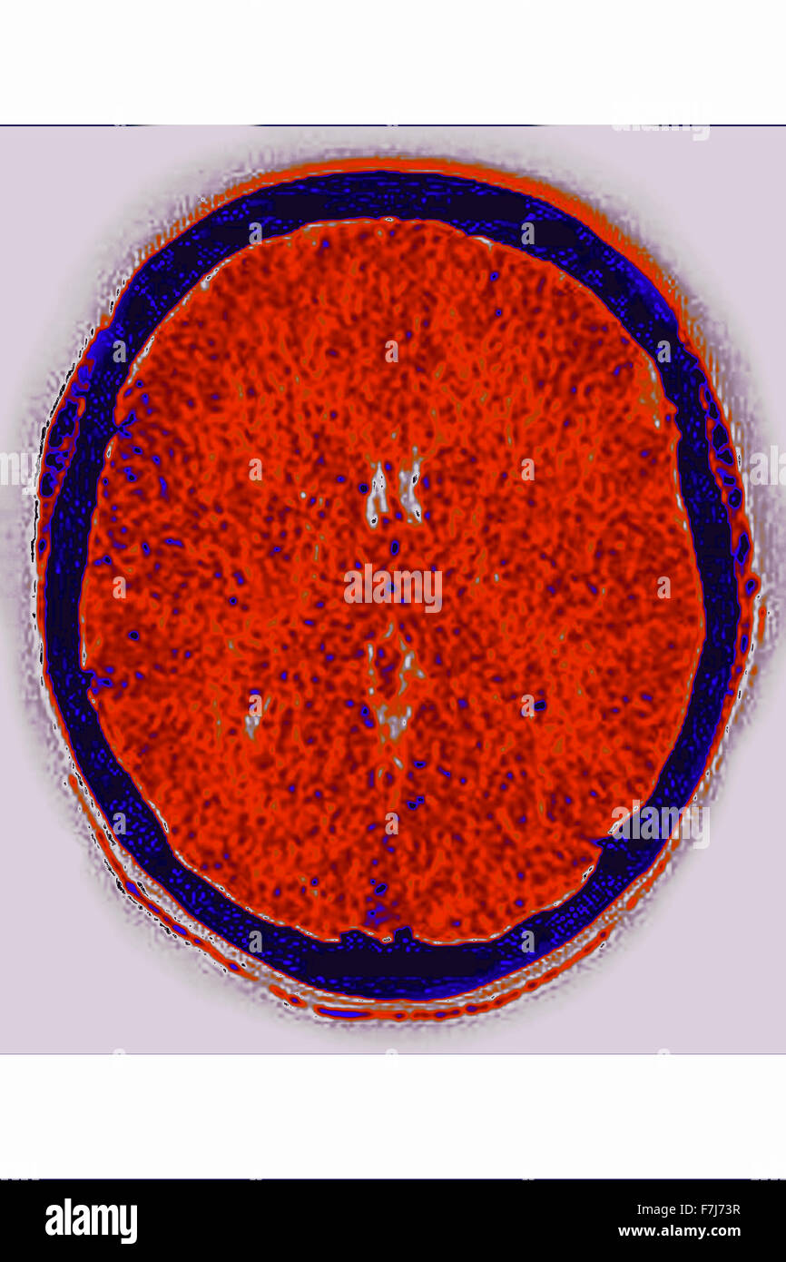 BRAIN EDEMA CT SCAN Stock Photo Alamy
