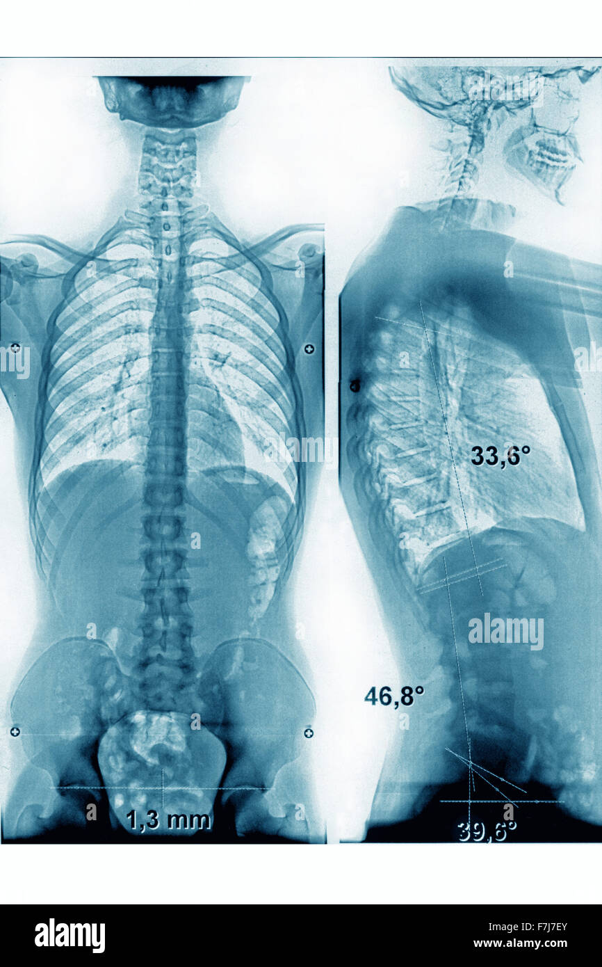 X ray normal lumbar spine hires stock photography and images Alamy