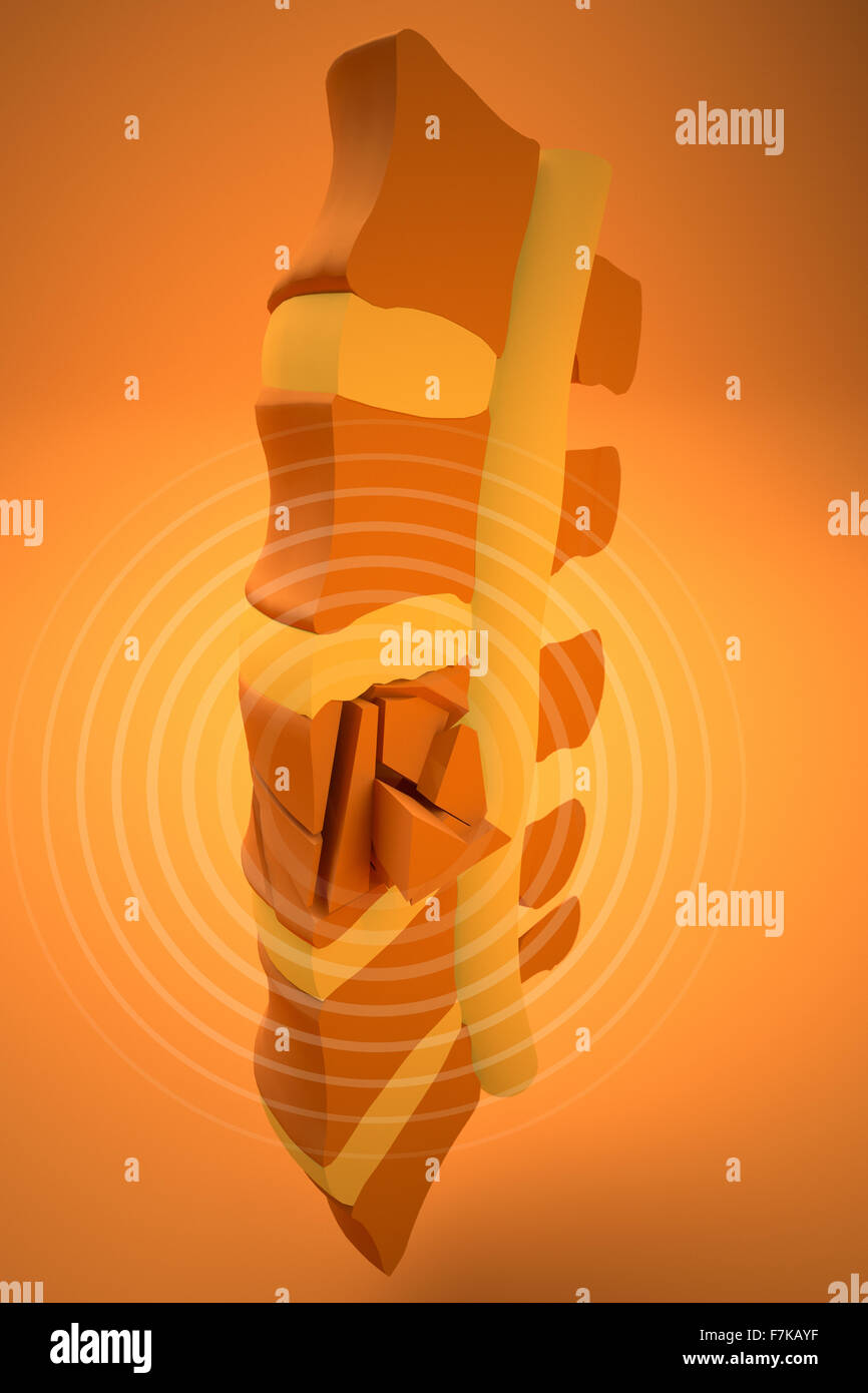 Spine, marrow, traumatic fractures vertebral, burst fracture. Spine section Stock Photo