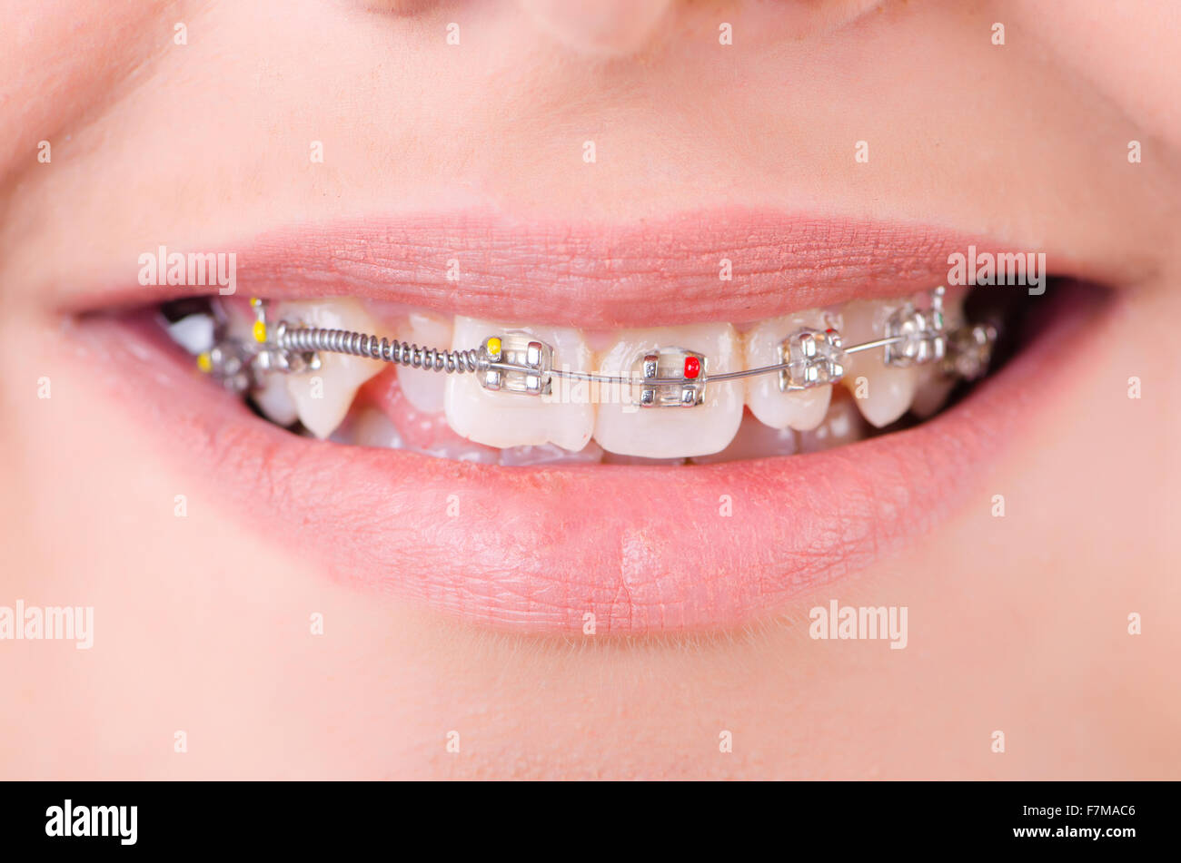 Mouth with brackets braces in medical concept Stock Photo - Alamy