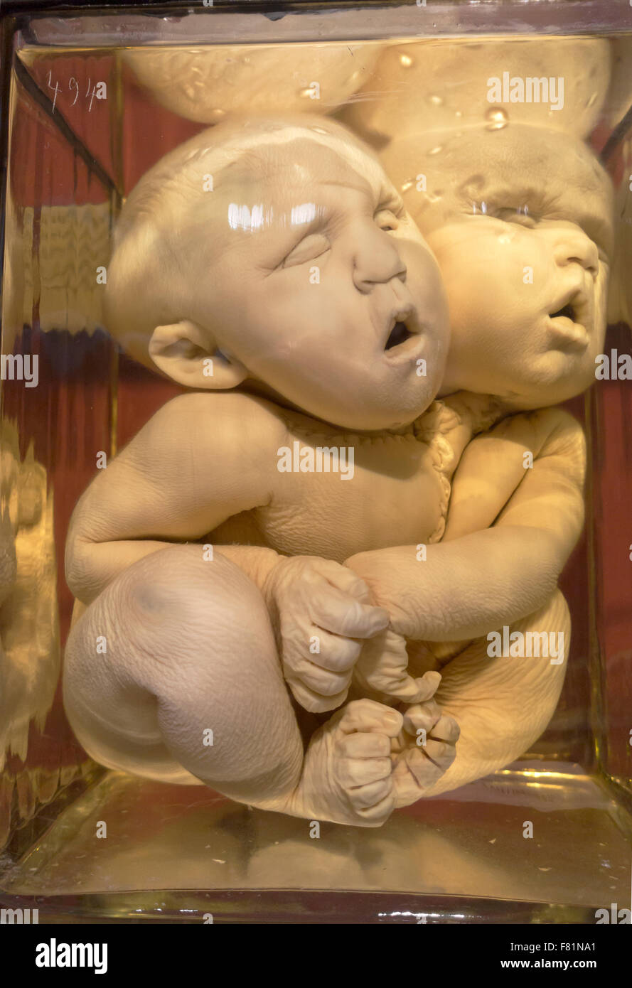 Conjoined twins, separate upper parts, preserved in formalin jar.  Medical Museion in Copenhagen. Stock Photo